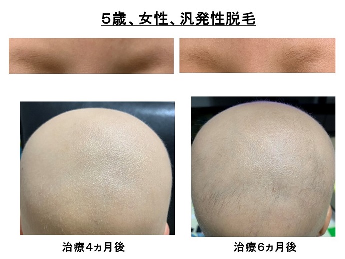 汎発性脱毛　病院
